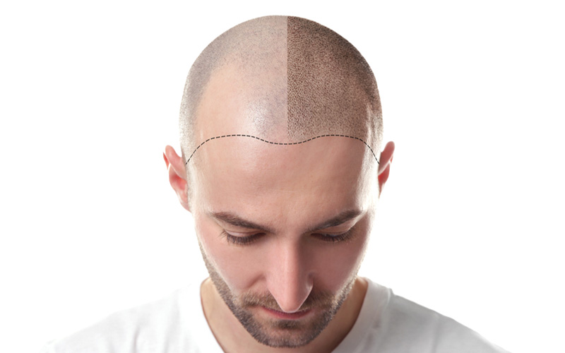 Mini Hair Transplant London for Receding Temples Explained