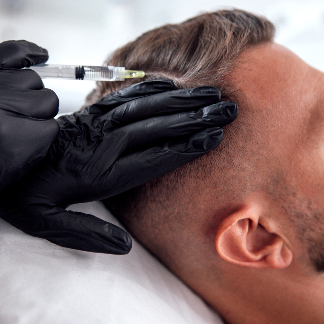 PRP Hair Treatment London: Results After Three Sessions