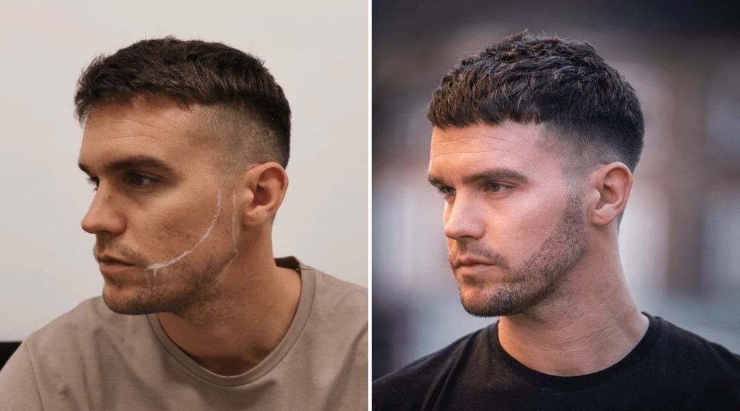 Beard Hair Transplant London and Facial Hair Density Explained